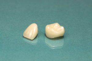 当院ではスタッフドクターともに、銀の詰め物・被せ物の人はいません。